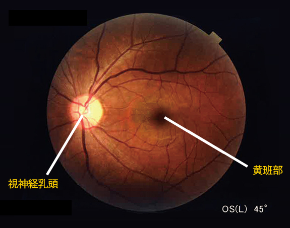 正常な眼底写真